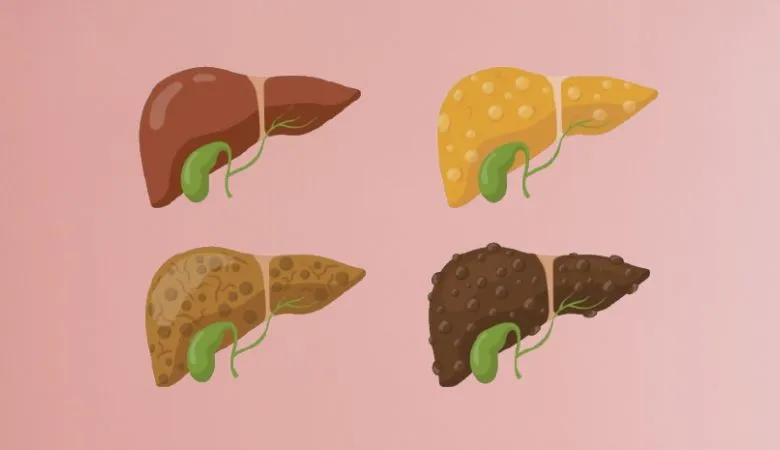 Signs of Liver Failure